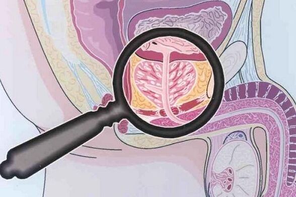 Enfermedad de prostatitis