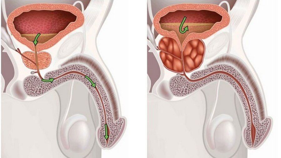 Prostatitis en hombres