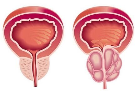 Síntomas de prostatitis en hombres